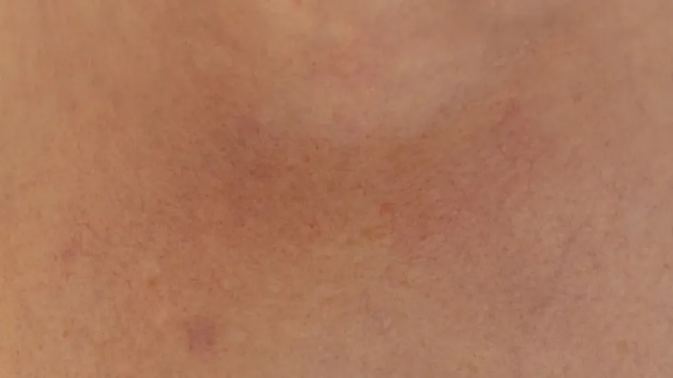 Rosácea facial: causas, qué funciona y qué evitar