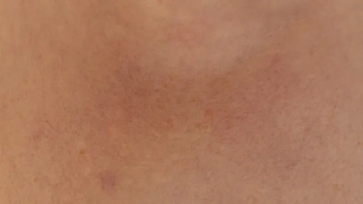 Rosácea facial: causas, tratamiento y cuidados